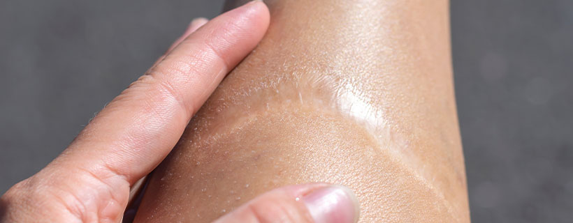 patient suffering from scar adhesions needing shockwave therapy in Pleasanton